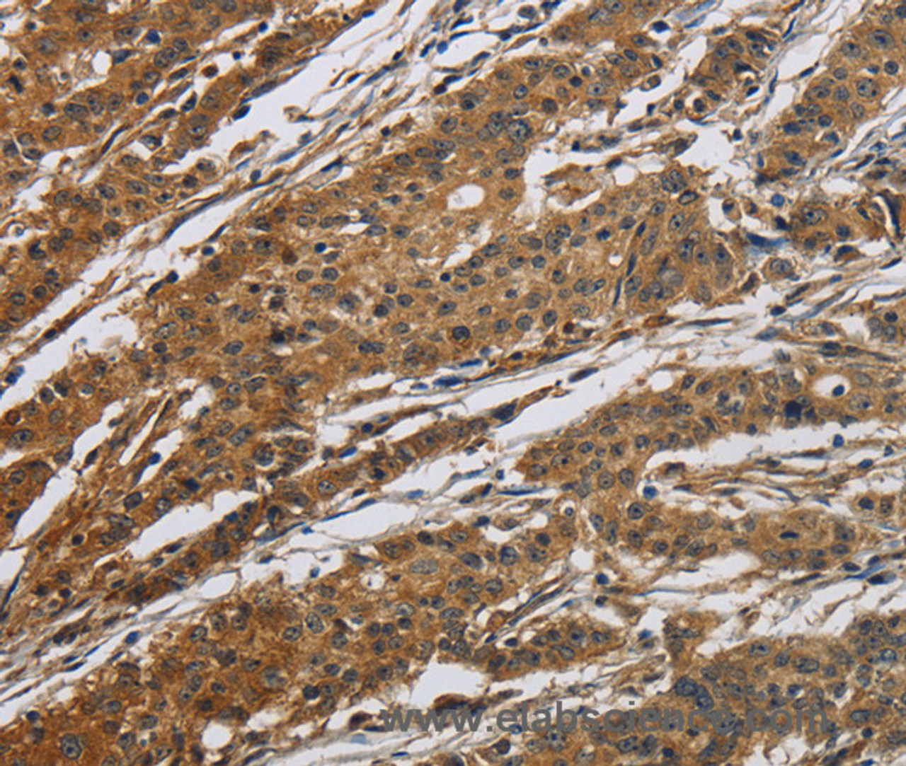 Immunohistochemistry of paraffin-embedded Human gastric cancer tissue using Claudin 2 Polyclonal Antibody at dilution 1:50