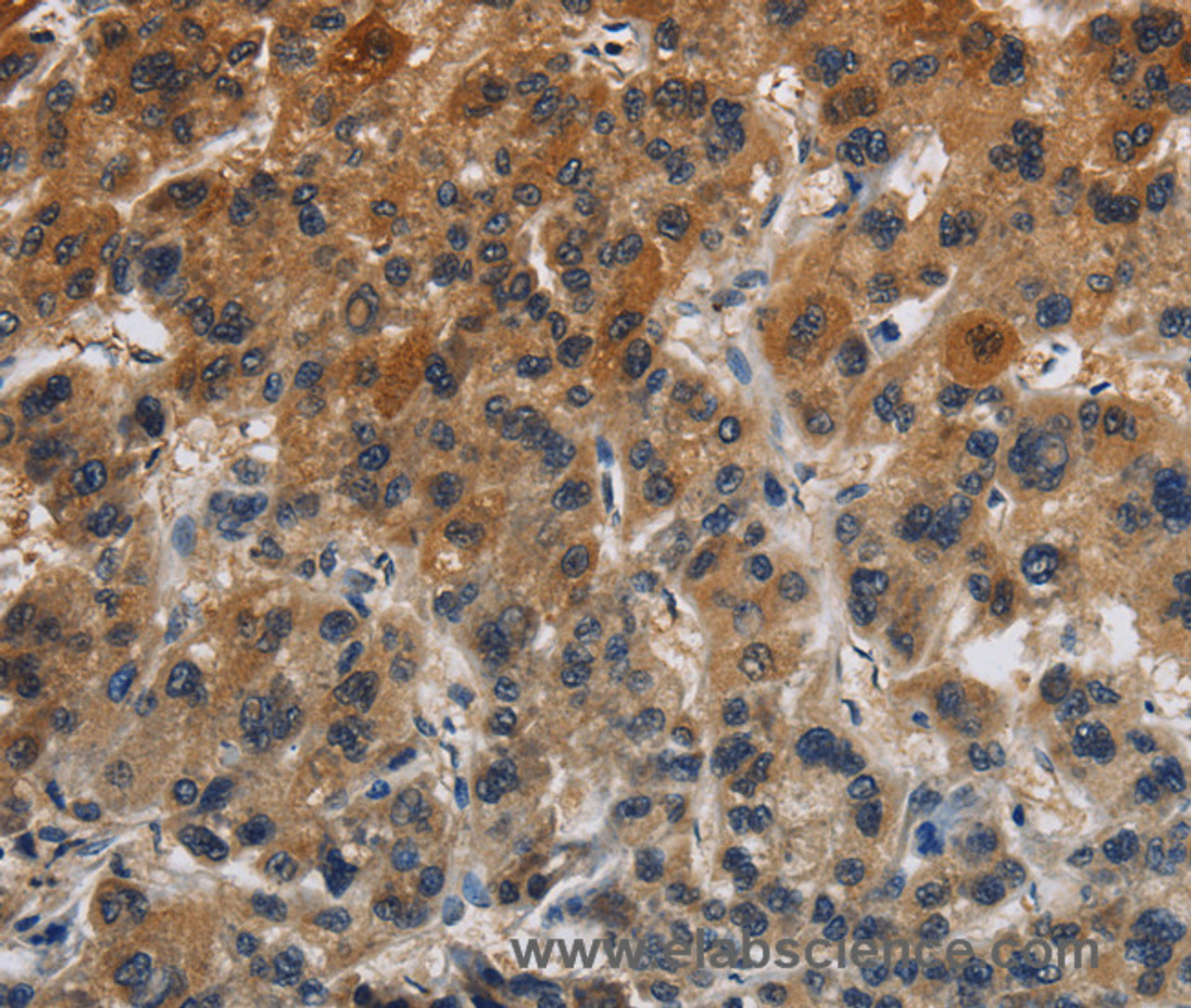 Immunohistochemistry of paraffin-embedded Human liver cancer tissue using Claudin 8 Polyclonal Antibody at dilution 1:50