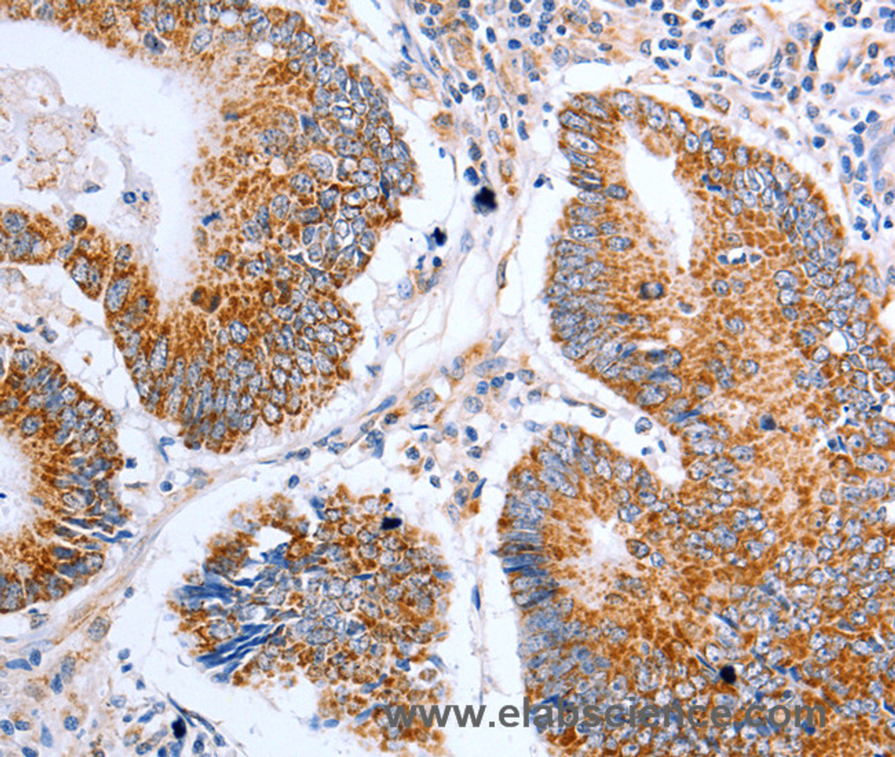 Immunohistochemistry of paraffin-embedded Human colon cancer tissue using Claudin 10 Polyclonal Antibody at dilution 1:50