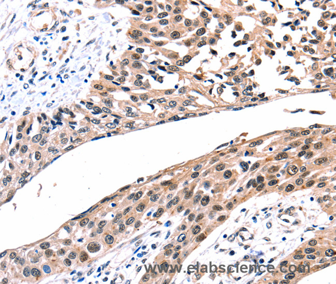 Immunohistochemistry of paraffin-embedded Human esophagus cancer tissue using Connexin-26 Polyclonal Antibody at dilution 1:100