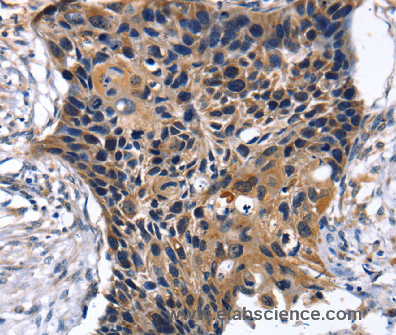 Immunohistochemistry of paraffin-embedded Human esophagus cancer tissue using SLC2A2 Polyclonal Antibody at dilution 1:35