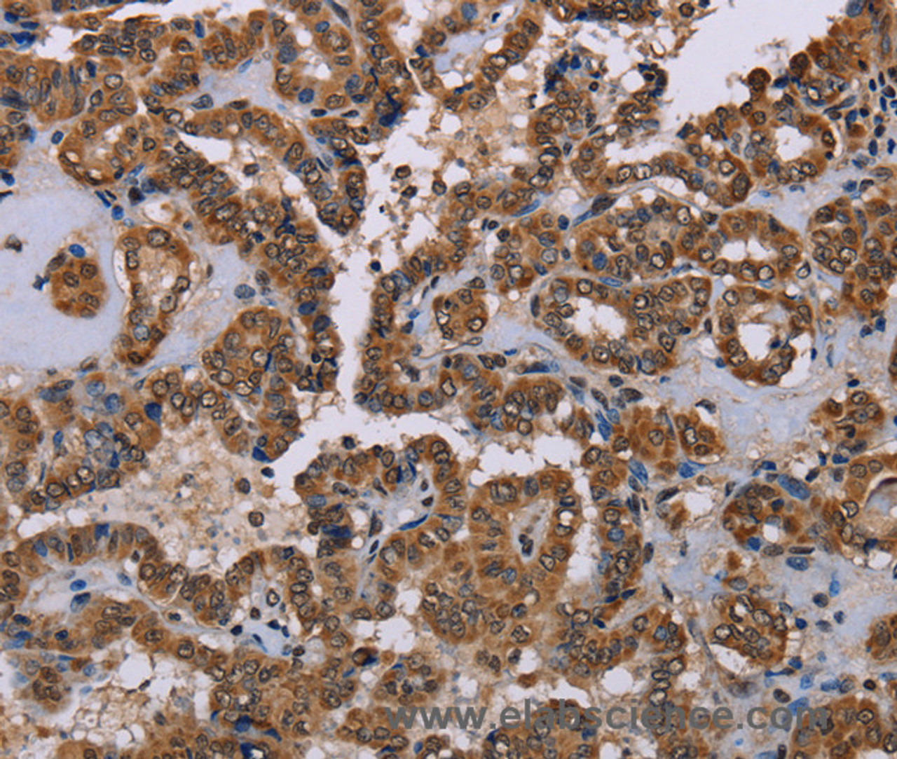 Immunohistochemistry of paraffin-embedded Human thyroid cancer tissue using GRK1 Polyclonal Antibody at dilution 1:40