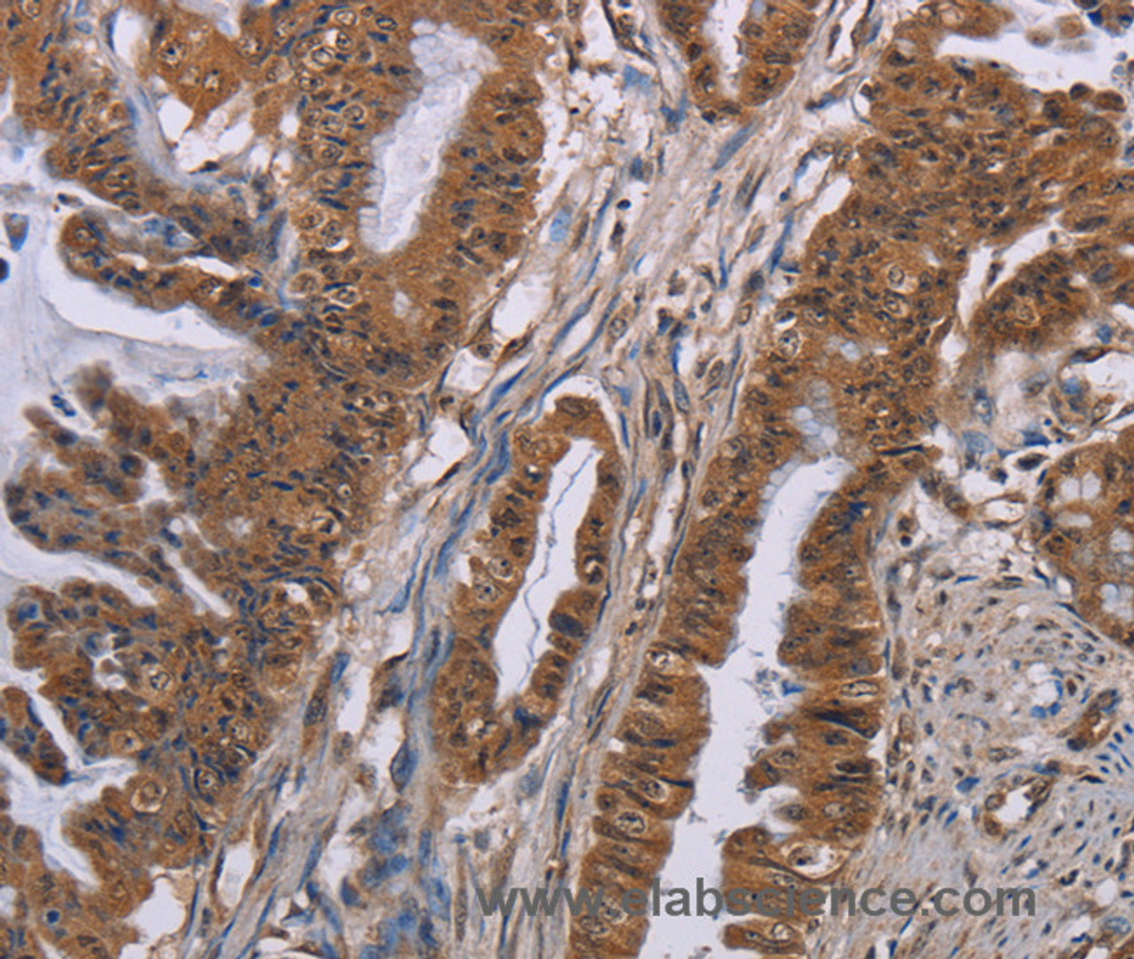 Immunohistochemistry of paraffin-embedded Human esophagus cancer tissue using GRK1 Polyclonal Antibody at dilution 1:40