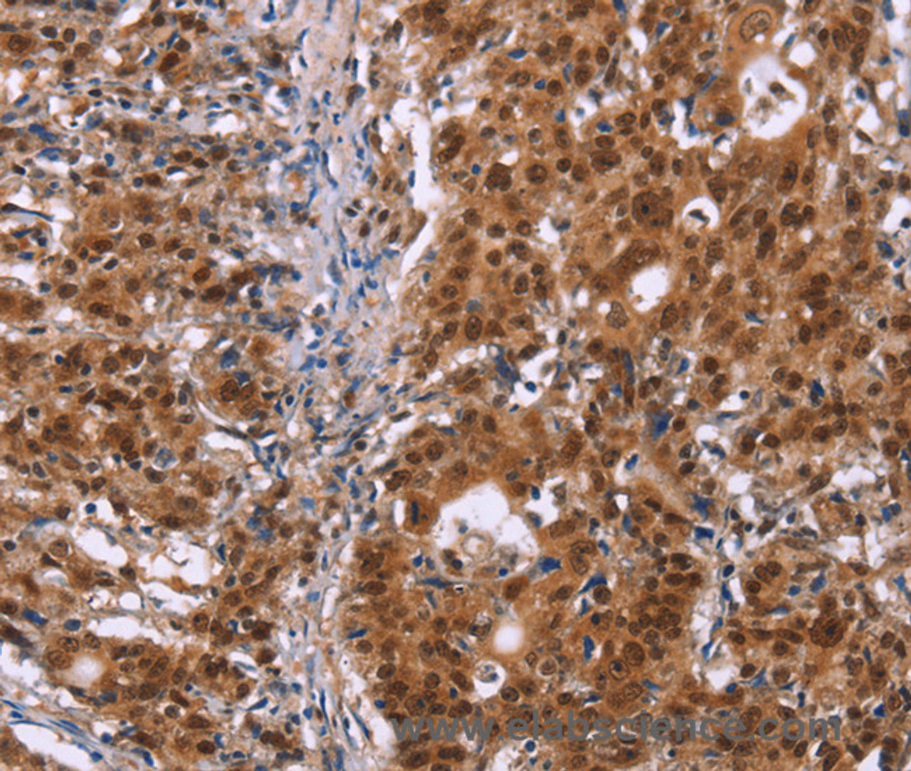 Immunohistochemistry of paraffin-embedded Human gastic cancer using CBX3 Polyclonal Antibody at dilution of 1:40