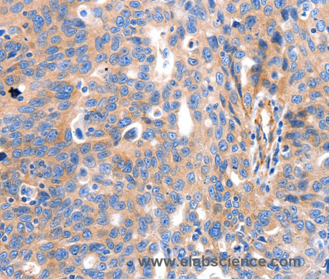Immunohistochemistry of paraffin-embedded Human ovarian cancer tissue using IGFBP7 Polyclonal Antibody at dilution 1:50