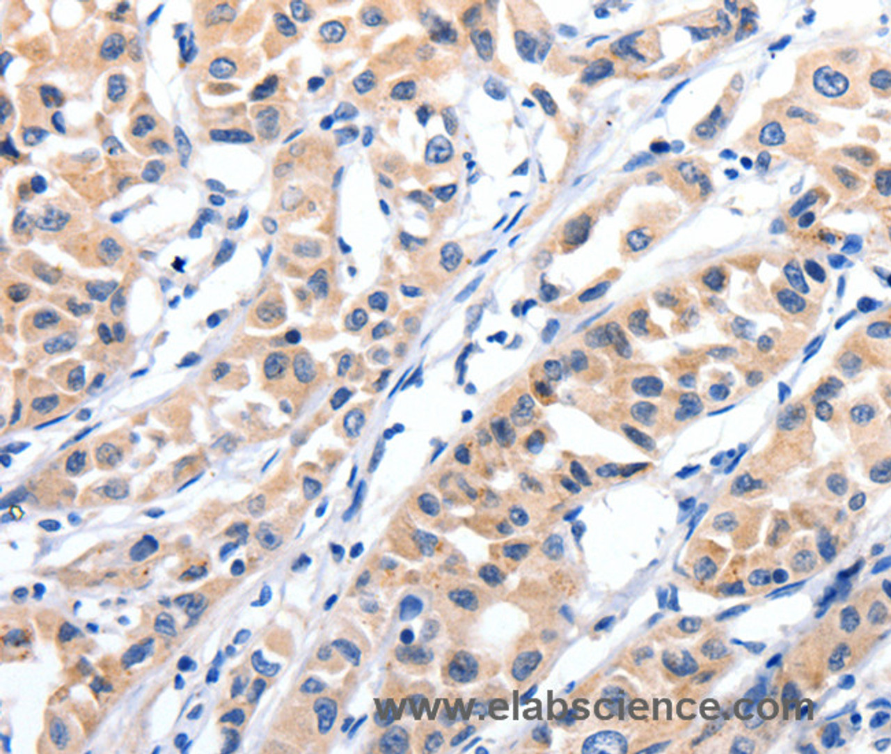 Immunohistochemistry of paraffin-embedded Human lung cancer tissue using JAK2 Polyclonal Antibody at dilution 1:35