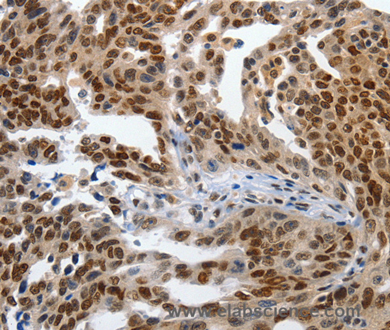 Immunohistochemistry of paraffin-embedded Human ovarian cancer using KLF5 Polyclonal Antibody at dilution of 1:120