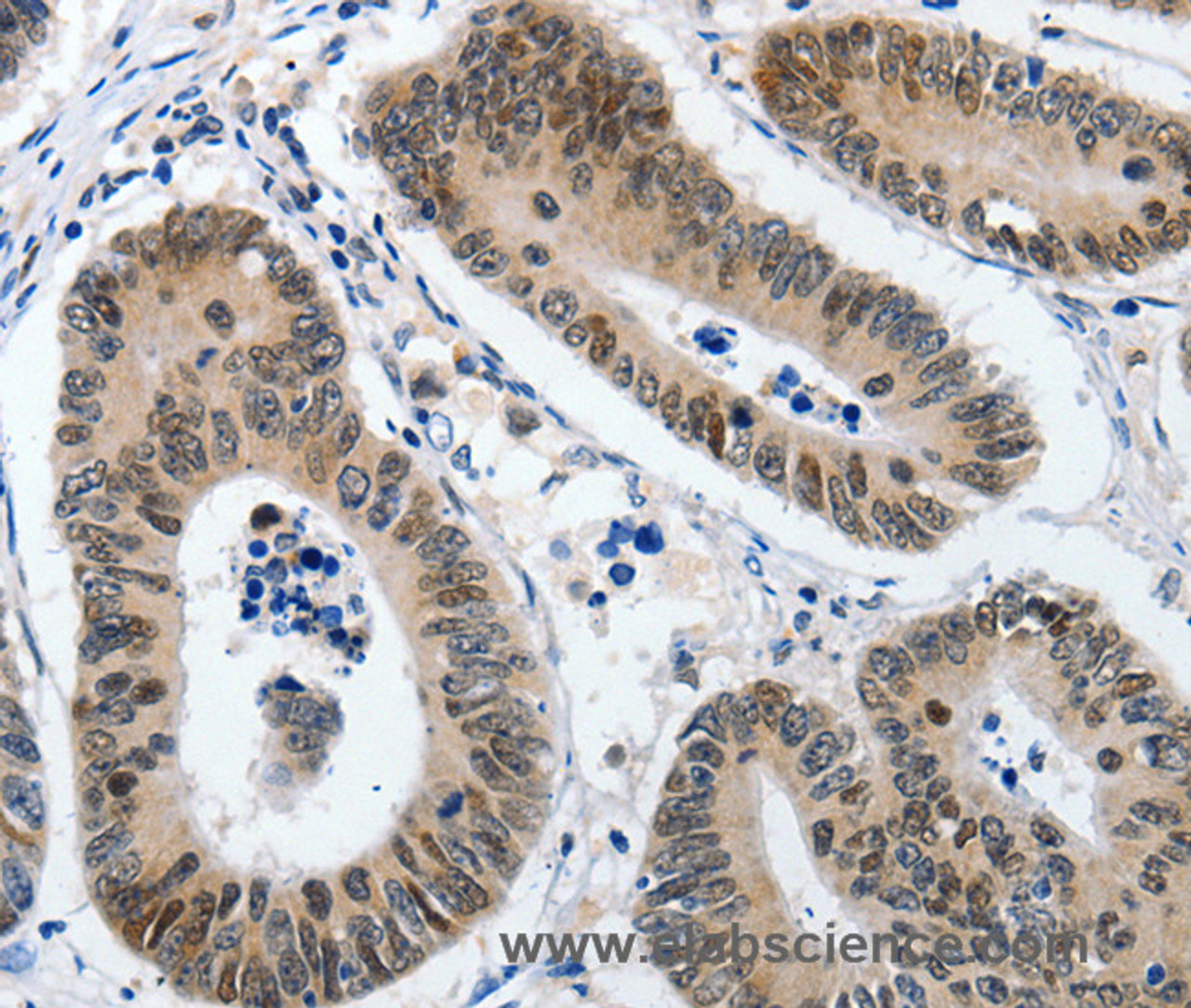 Immunohistochemistry of paraffin-embedded Human colon cancer using KLF5 Polyclonal Antibody at dilution of 1:120