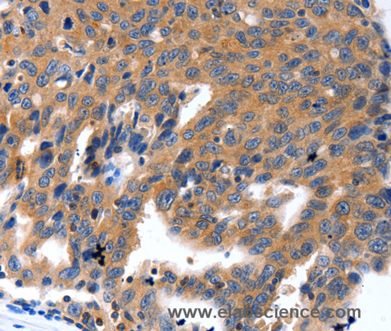 Immunohistochemistry of paraffin-embedded Human ovarian cancer using KLK5 Polyclonal Antibody at dilution of 1:100