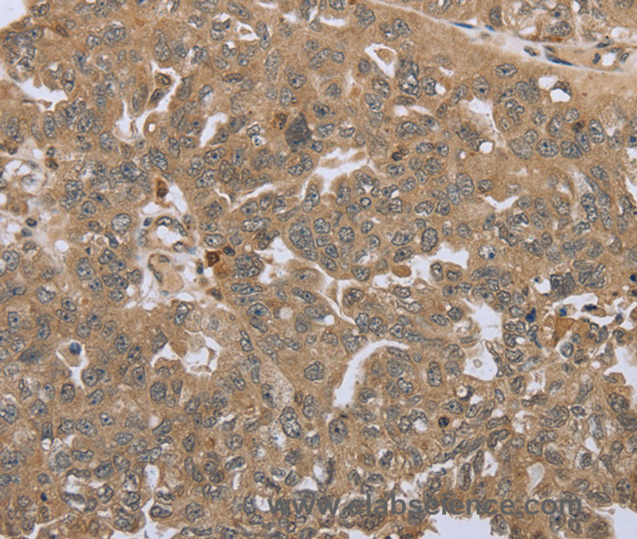 Immunohistochemistry of paraffin-embedded Human ovarian cancer tissue using STMN2/3/4 Polyclonal Antibody at dilution 1:45