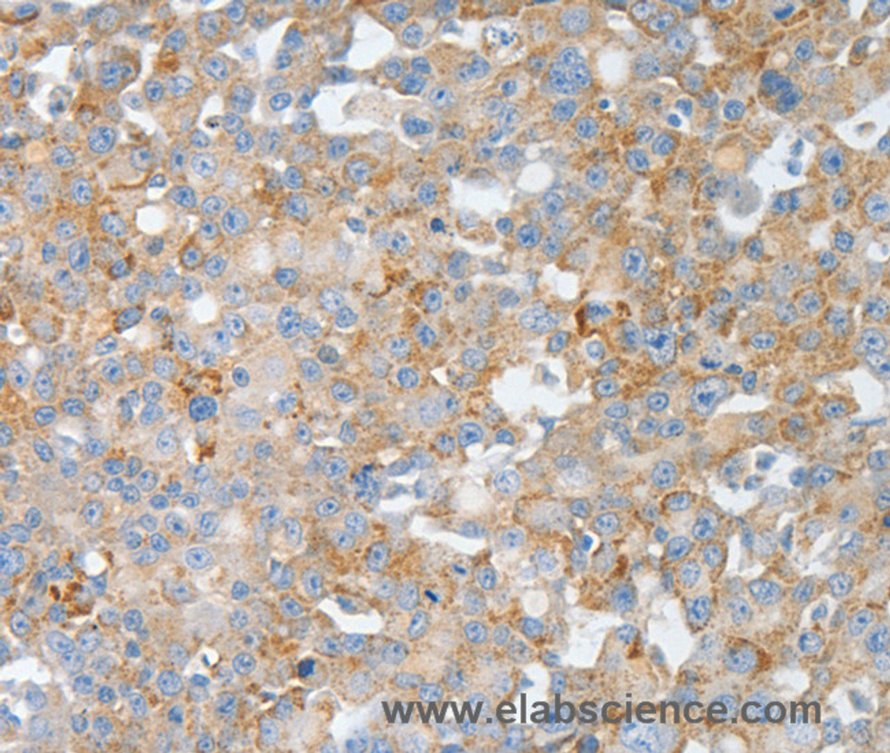 Immunohistochemistry of paraffin-embedded Human breast cancer using BPIFB2 Polyclonal Antibody at dilution of 1:50