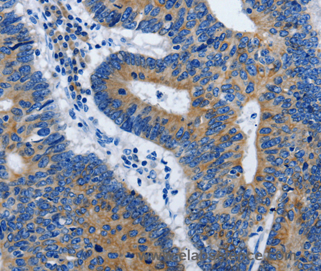 Immunohistochemistry of paraffin-embedded Human colon cancer using BPIFB3 Polyclonal Antibody at dilution of 1:50