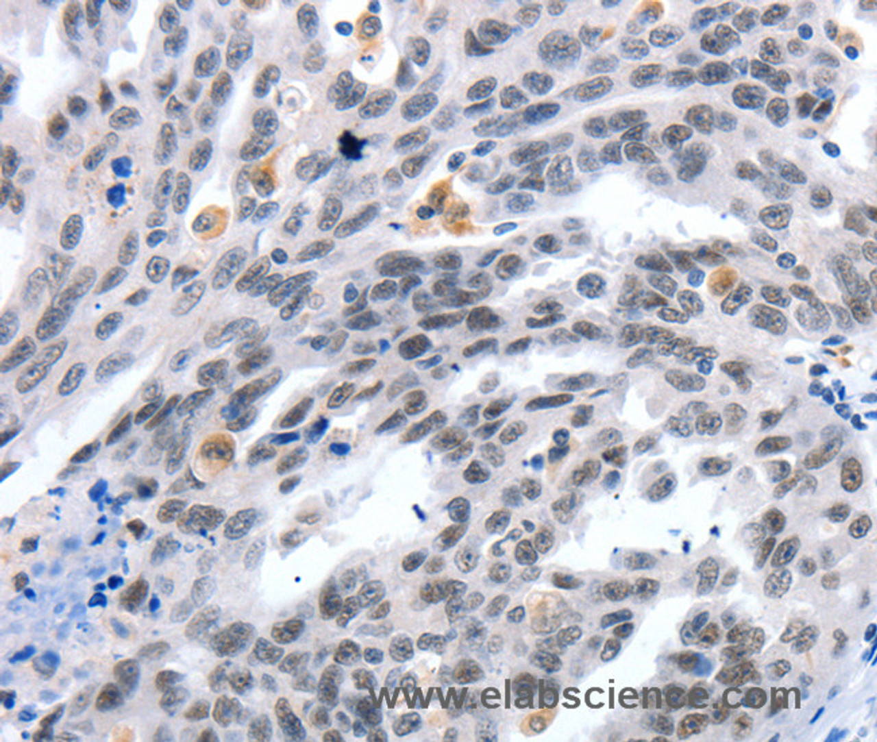 Immunohistochemistry of paraffin-embedded Human ovarian cancer tissue using LRP5 Polyclonal Antibody at dilution 1:55
