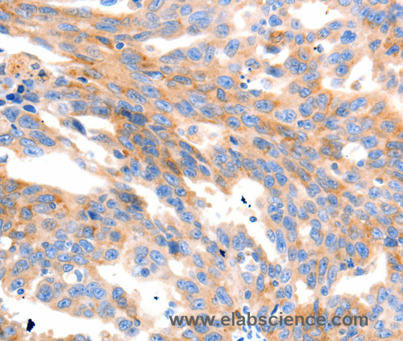 Immunohistochemistry of paraffin-embedded Human ovarian cancer using MAP2K2 Polyclonal Antibody at dilution of 1:100