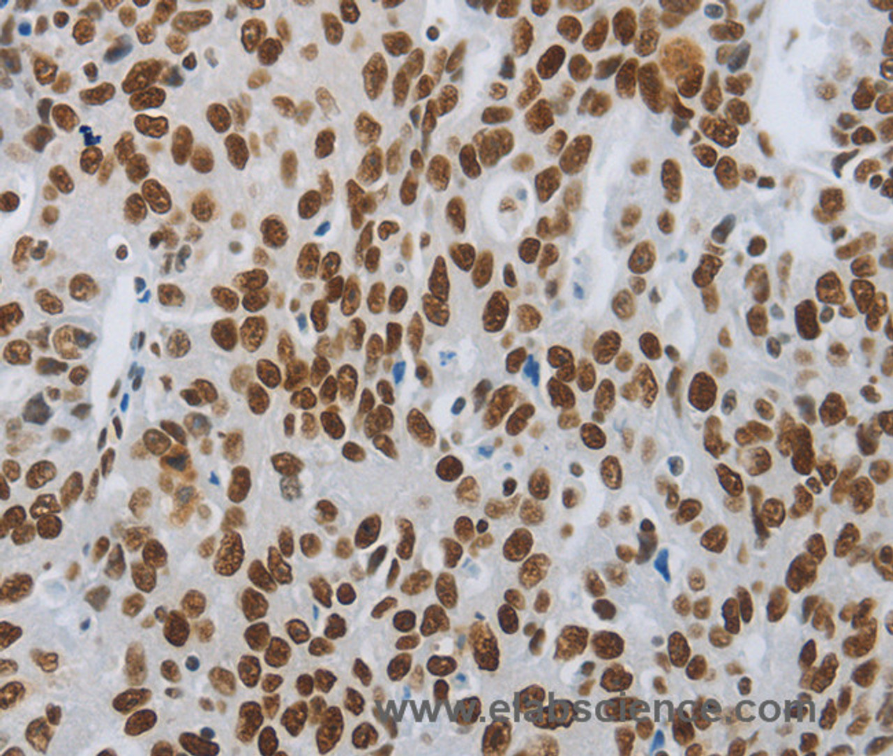 Immunohistochemistry of paraffin-embedded Human ovarian cancer tissue using SLC16A14 Polyclonal Antibody at dilution 1:80