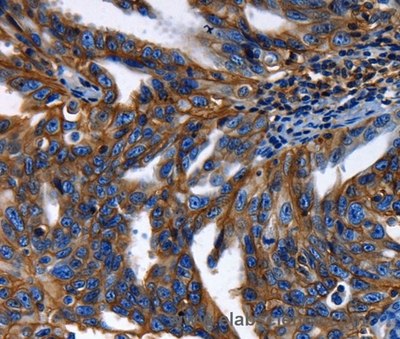 Immunohistochemistry of paraffin-embedded Human ovarian cancer using ABCC5 Polyclonal Antibody at dilution of 1:50