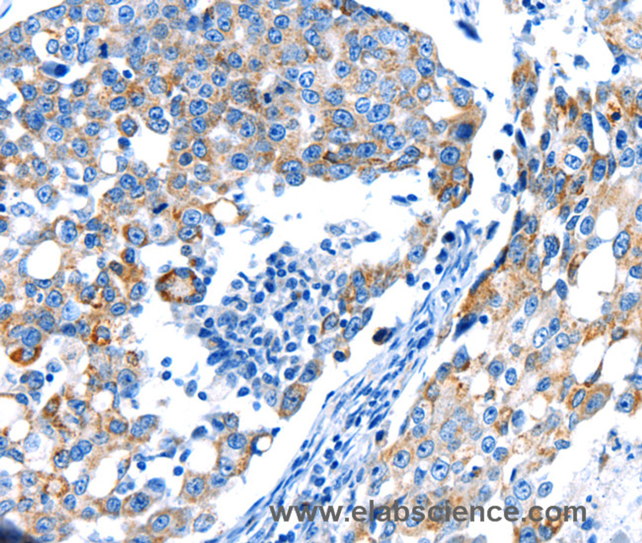 Immunohistochemistry of paraffin-embedded Human breast cancer using POMC Polyclonal Antibody at dilution of 1:30