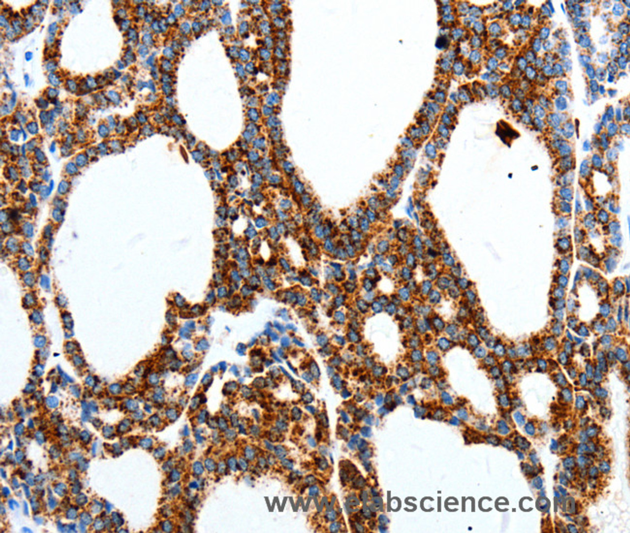 Immunohistochemistry of paraffin-embedded Human thyroid cancer using MTNR1A Polyclonal Antibody at dilution of 1:40