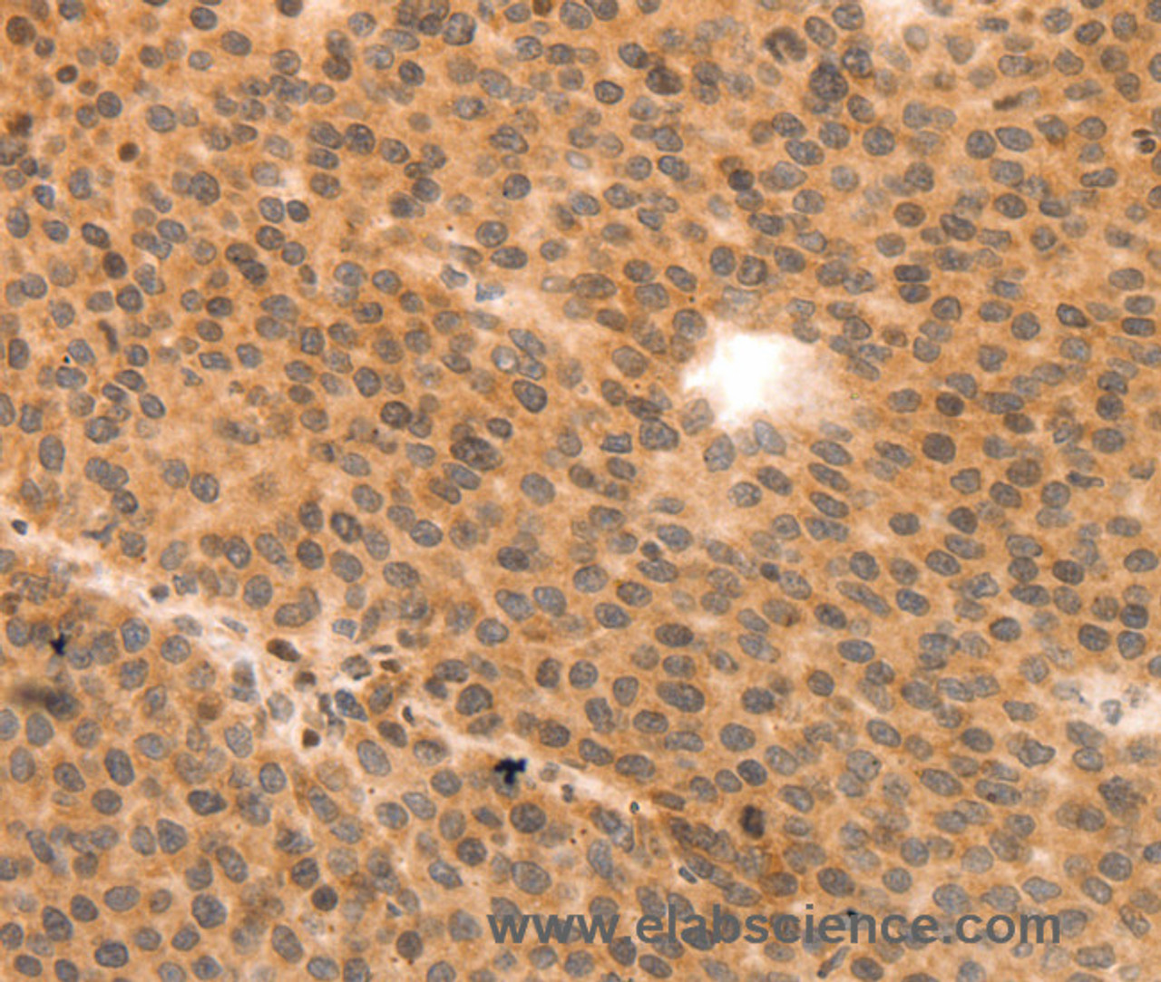 Immunohistochemistry of paraffin-embedded Human liver cancer using MYL9 Polyclonal Antibody at dilution of 1:80