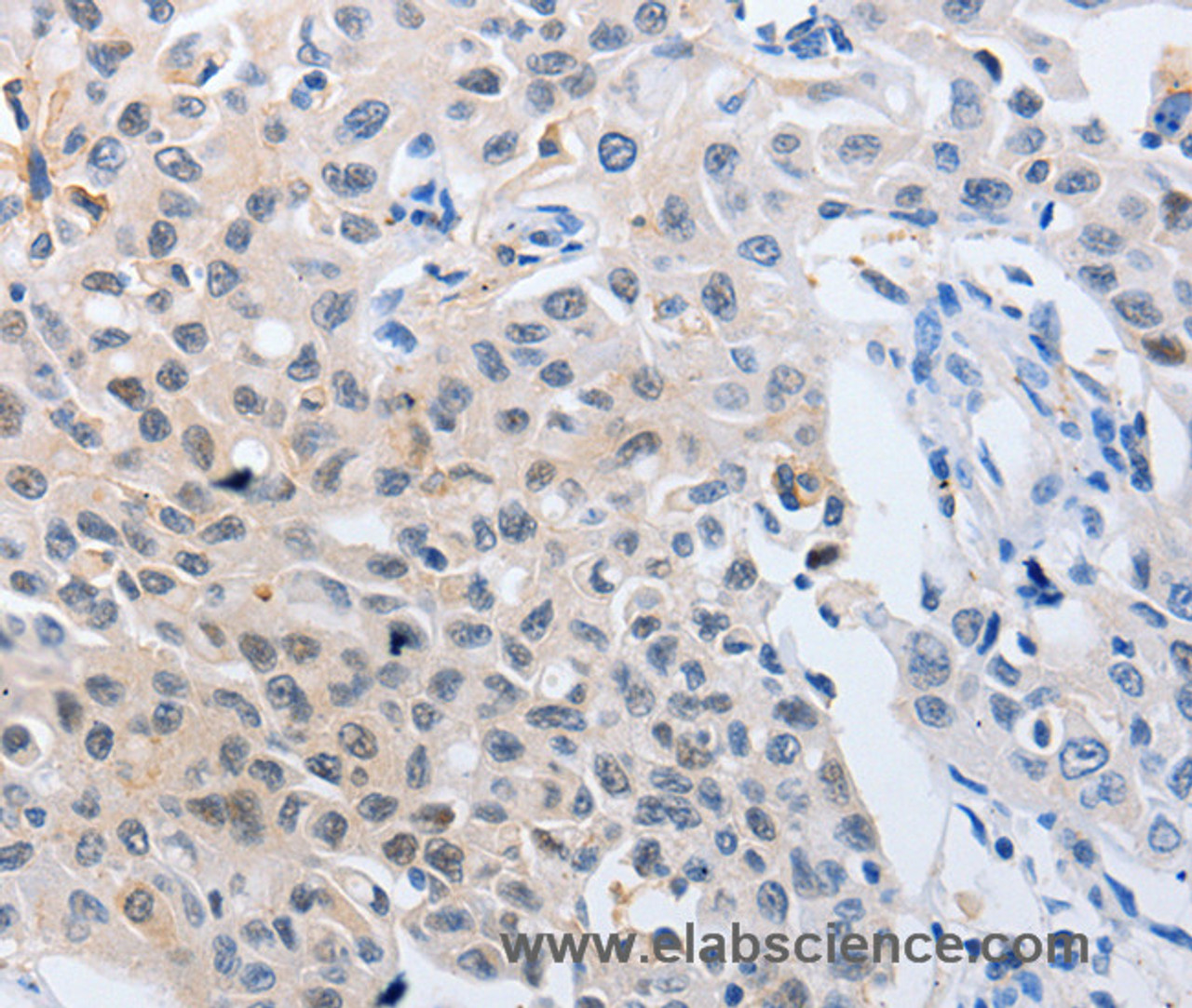 Immunohistochemistry of paraffin-embedded Human lung cancer using 14-3-3 theta Polyclonal Antibody at dilution of 1:50
