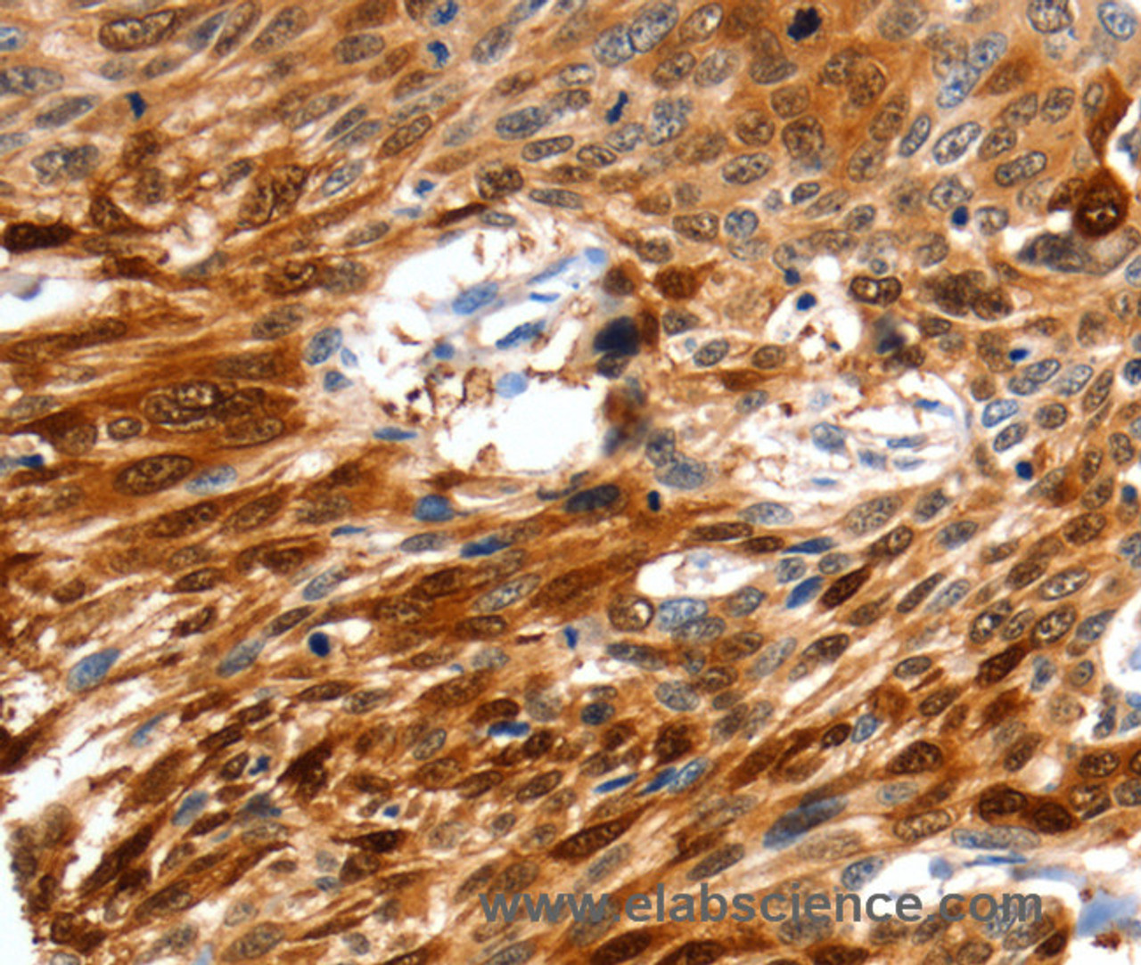 Immunohistochemistry of paraffin-embedded Human esophagus cancer tissue using NCOR1 Polyclonal Antibody at dilution 1:60