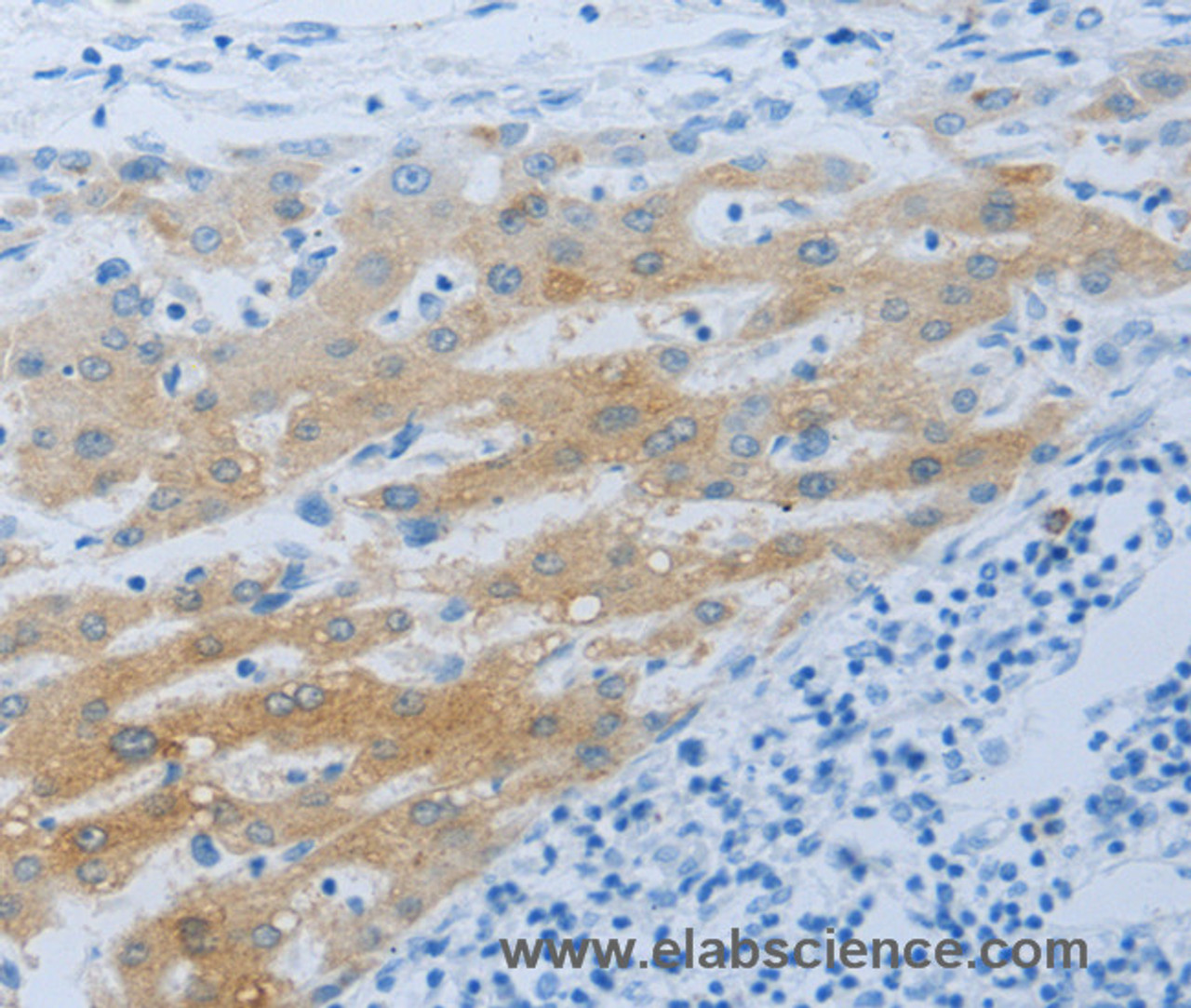 Immunohistochemistry of paraffin-embedded Human liver cancer using NPHS1 Polyclonal Antibody at dilution of 1:50