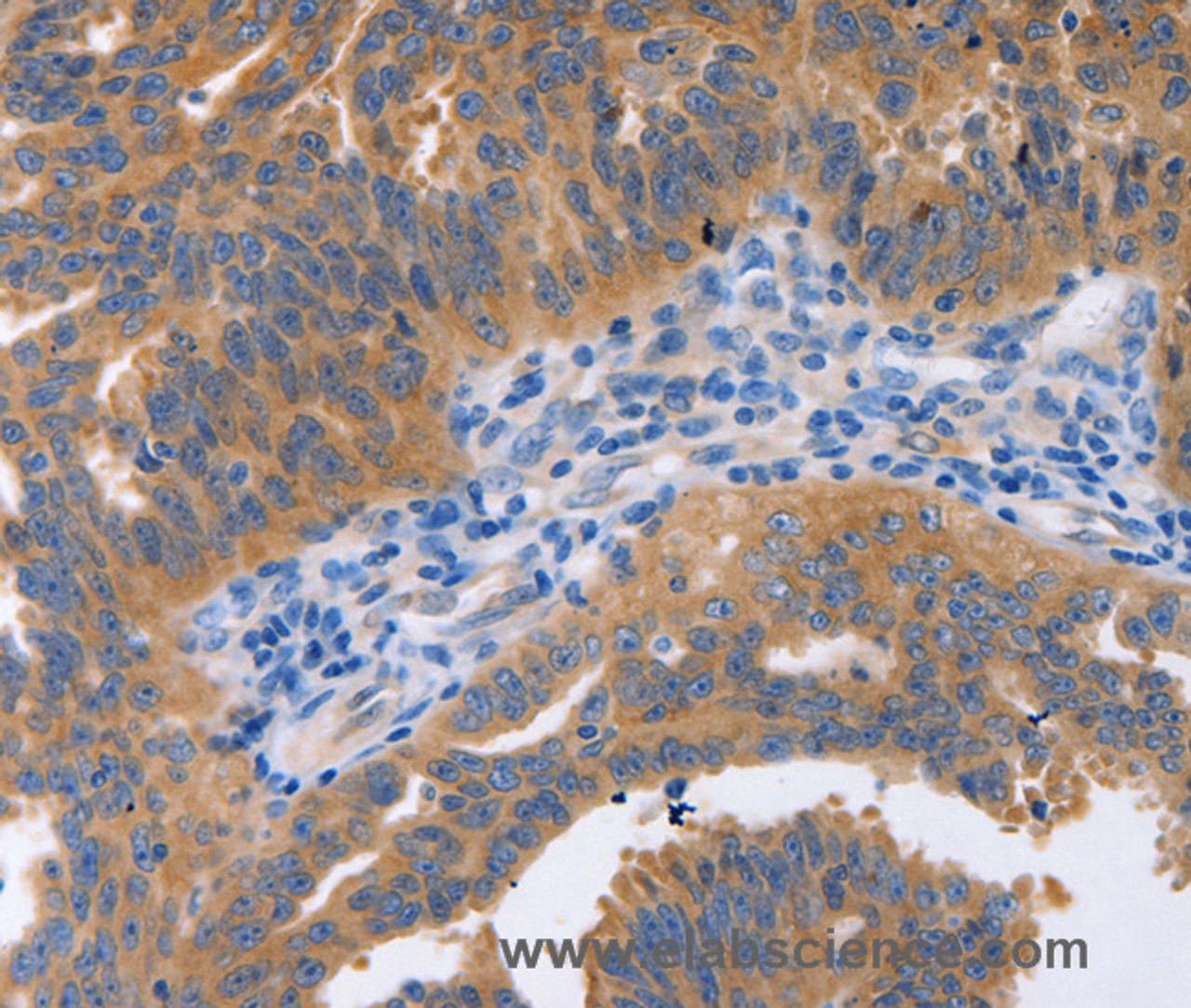 Immunohistochemistry of paraffin-embedded Human ovarian cancer tissue using NBEA Polyclonal Antibody at dilution 1:60