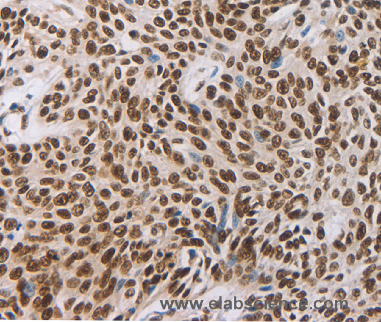 Immunohistochemistry of paraffin-embedded Human esophagus cancer using AKAP8 Polyclonal Antibody at dilution of 1:30