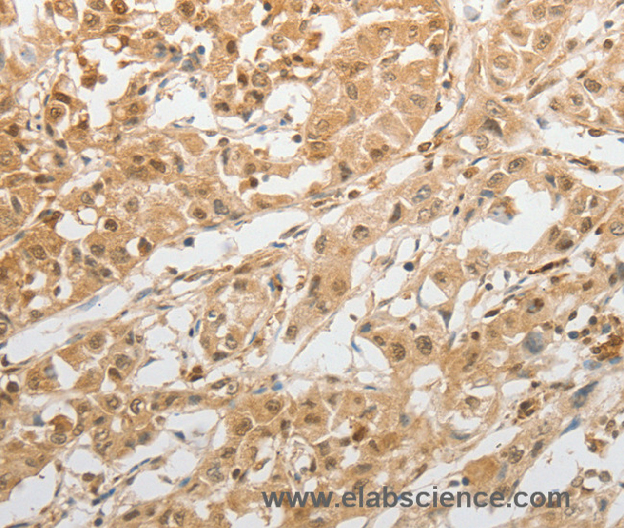 Immunohistochemistry of paraffin-embedded Human lung cancer tissue using GRIN2C Polyclonal Antibody at dilution 1:100