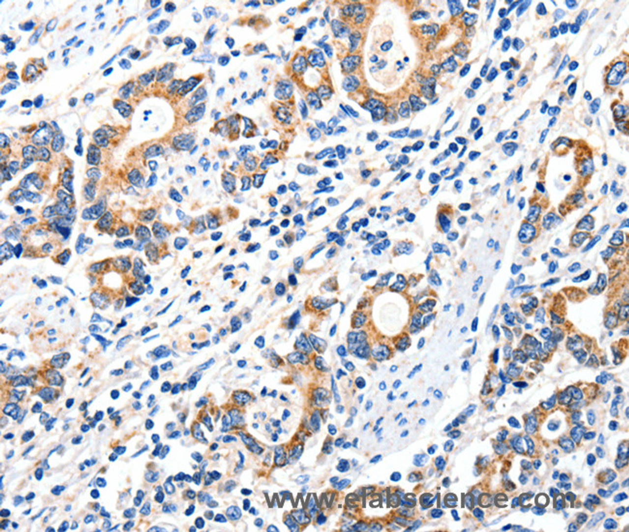 Immunohistochemistry of paraffin-embedded Human gasrtic cancer tissue using GluR2 Polyclonal Antibody at dilution 1:40
