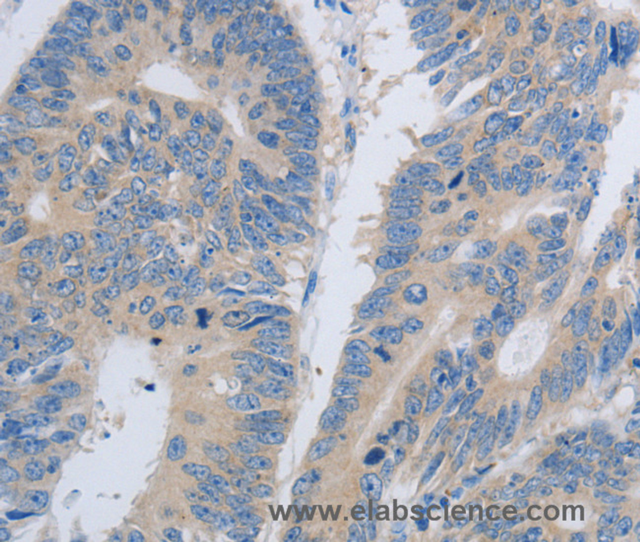 Immunohistochemistry of paraffin-embedded Human colon cancer using PAWR Polyclonal Antibody at dilution of 1:60