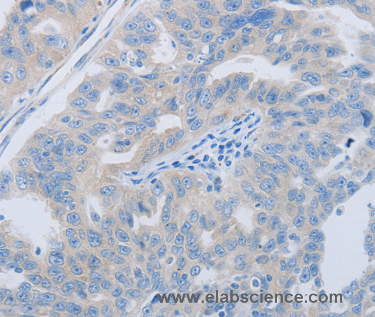 Immunohistochemistry of paraffin-embedded Human ovarian cancer using PAWR Polyclonal Antibody at dilution of 1:60