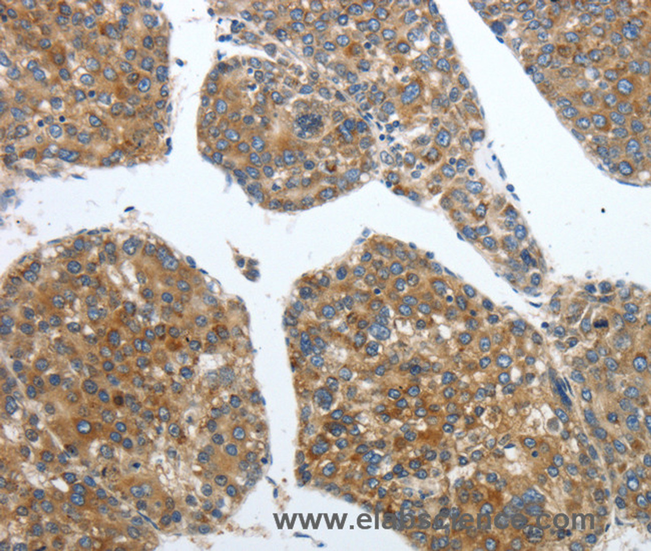 Immunohistochemistry of paraffin-embedded Human liver cancer using PDK2 Polyclonal Antibody at dilution of 1:40