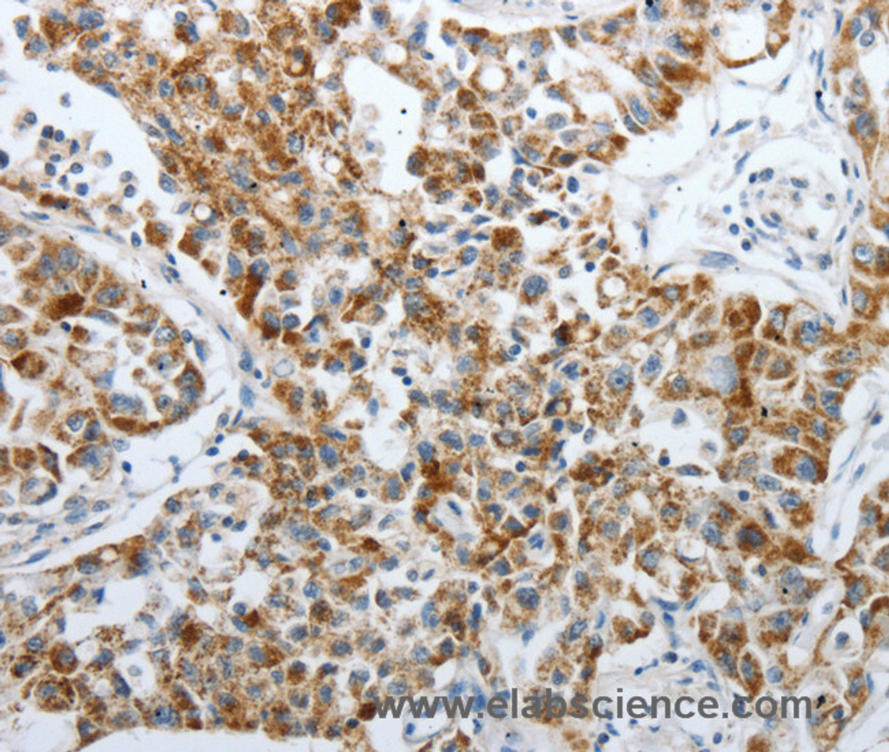 Immunohistochemistry of paraffin-embedded Human lung cancer using PDK2 Polyclonal Antibody at dilution of 1:40