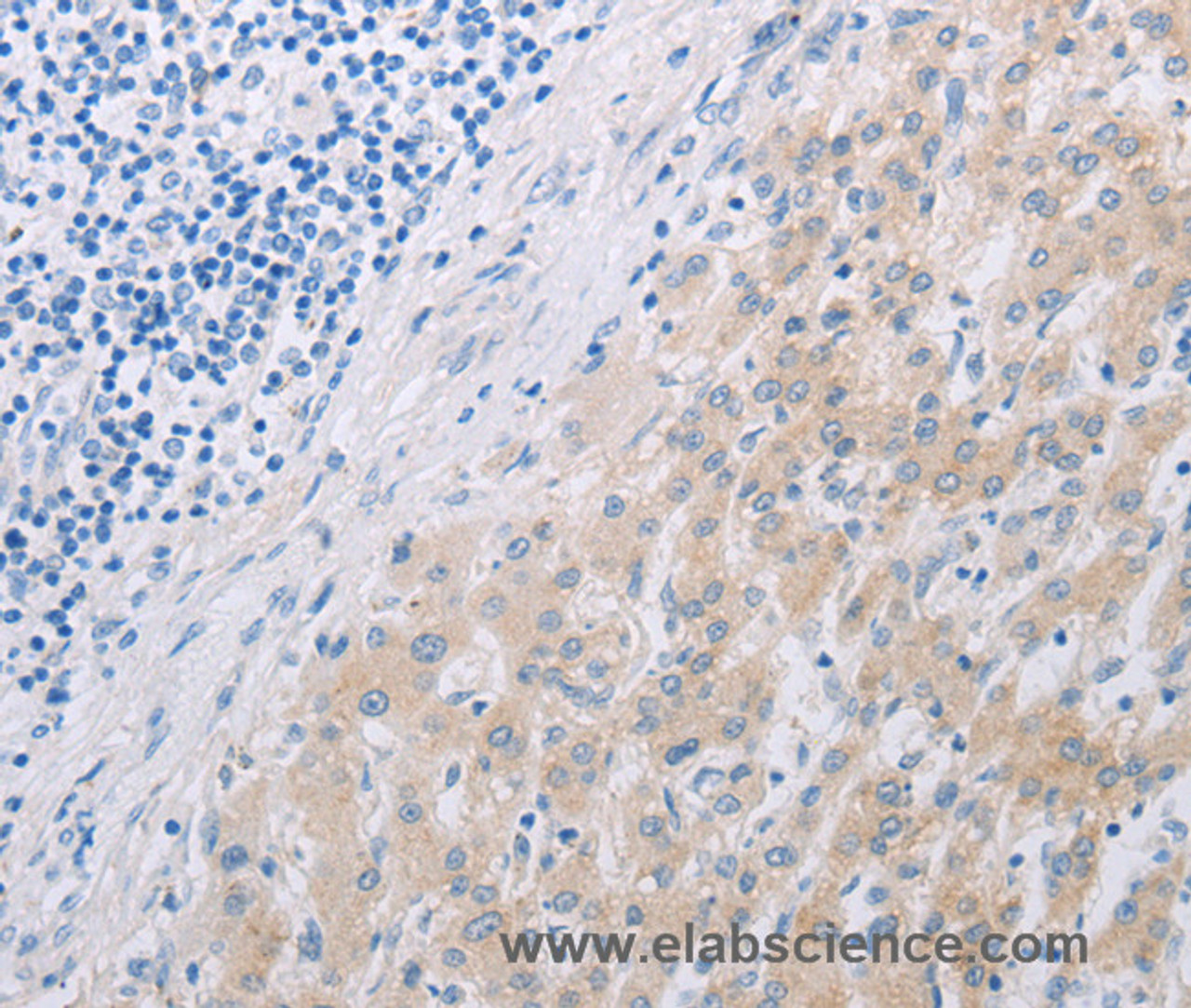 Immunohistochemistry of paraffin-embedded Human liver cancer using PFN2 Polyclonal Antibody at dilution of 1:30