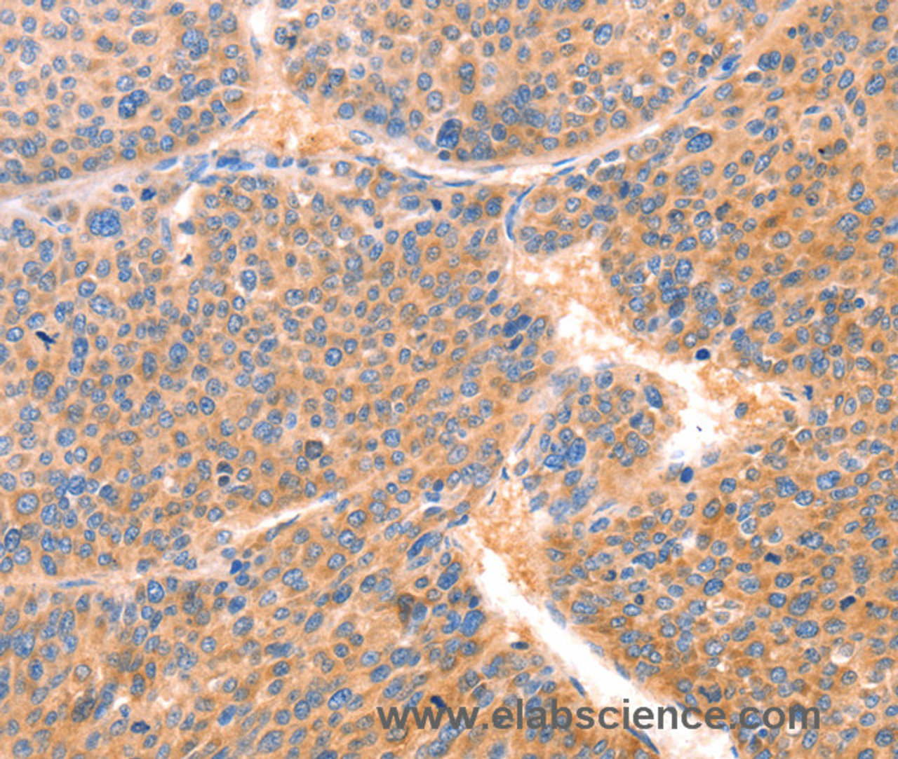 Immunohistochemistry of paraffin-embedded Human liver cancer using PRDX2 Polyclonal Antibody at dilution of 1:80