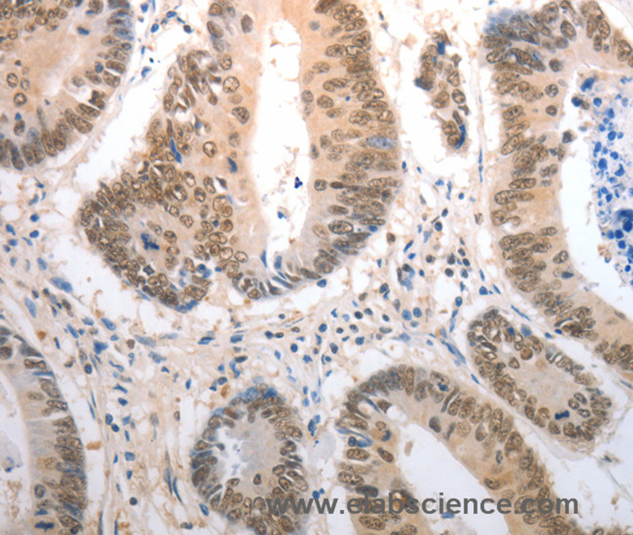 Immunohistochemistry of paraffin-embedded Human colon cancer using RAD50 Polyclonal Antibody at dilution of 1:40