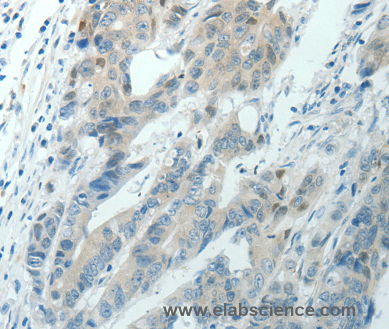 Immunohistochemistry of paraffin-embedded Human colon cancer using RNF126 Polyclonal Antibody at dilution of 1:70