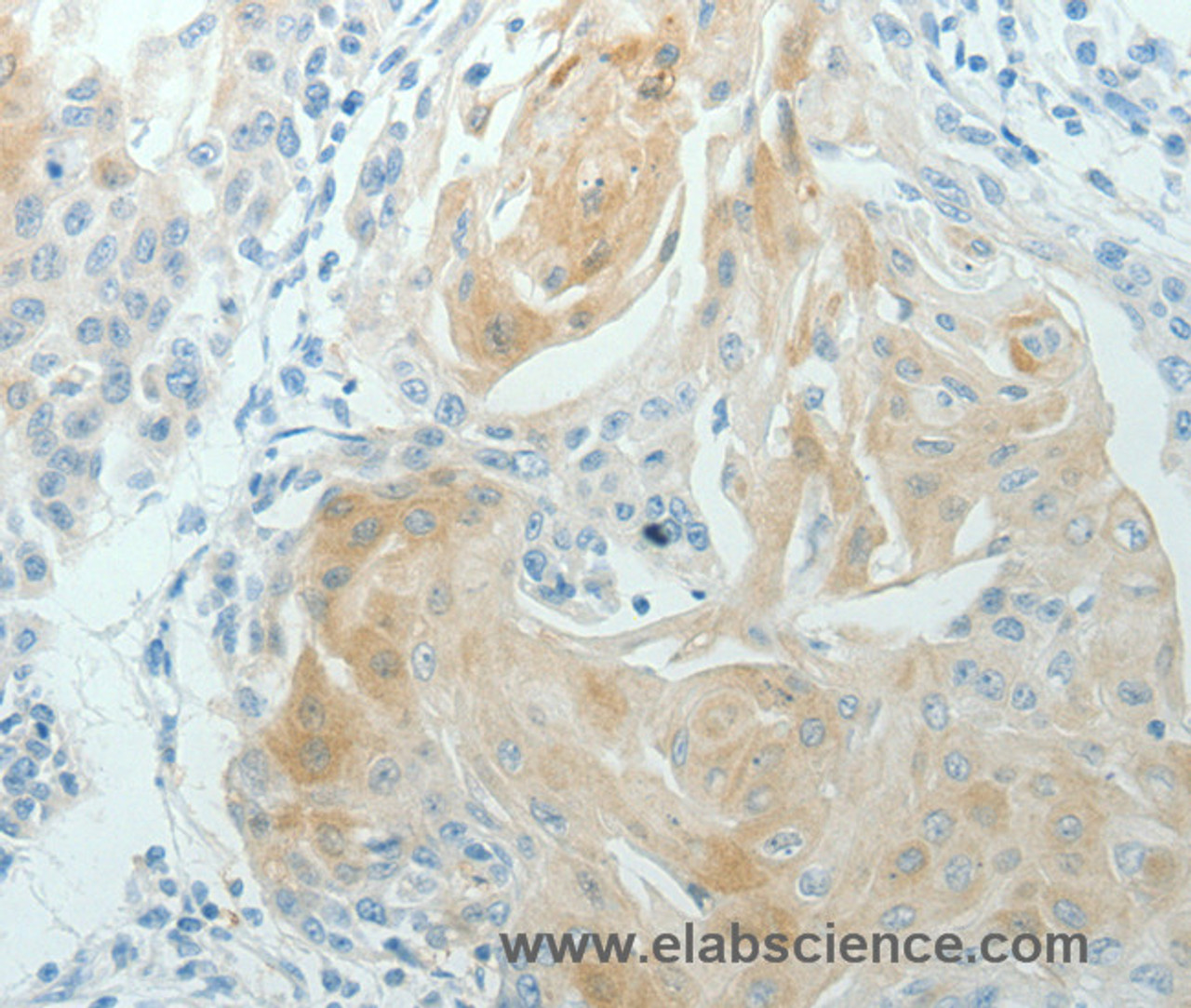 Immunohistochemistry of paraffin-embedded Human cervical cancer using RNF126 Polyclonal Antibody at dilution of 1:70