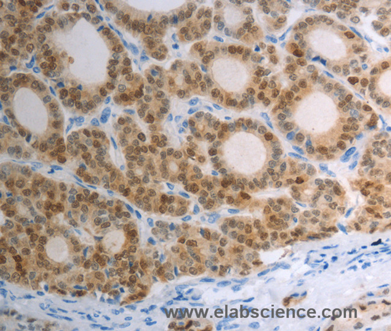 Immunohistochemistry of paraffin-embedded Human thyroid cancer tissue using S100A1 Polyclonal Antibody at dilution 1:40