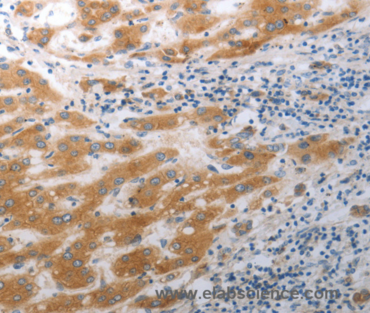 Immunohistochemistry of paraffin-embedded Human liver cancer tissue using SLC12A6 Polyclonal Antibody at dilution 1:40