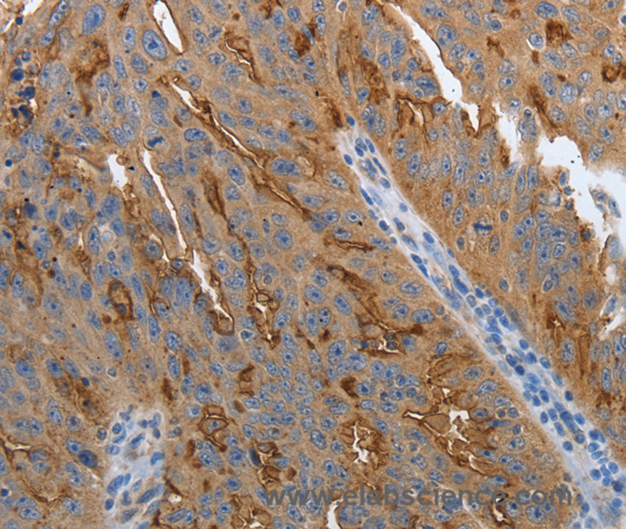Immunohistochemistry of paraffin-embedded Human ovarian cancer using SLC34A2 Polyclonal Antibody at dilution of 1:70