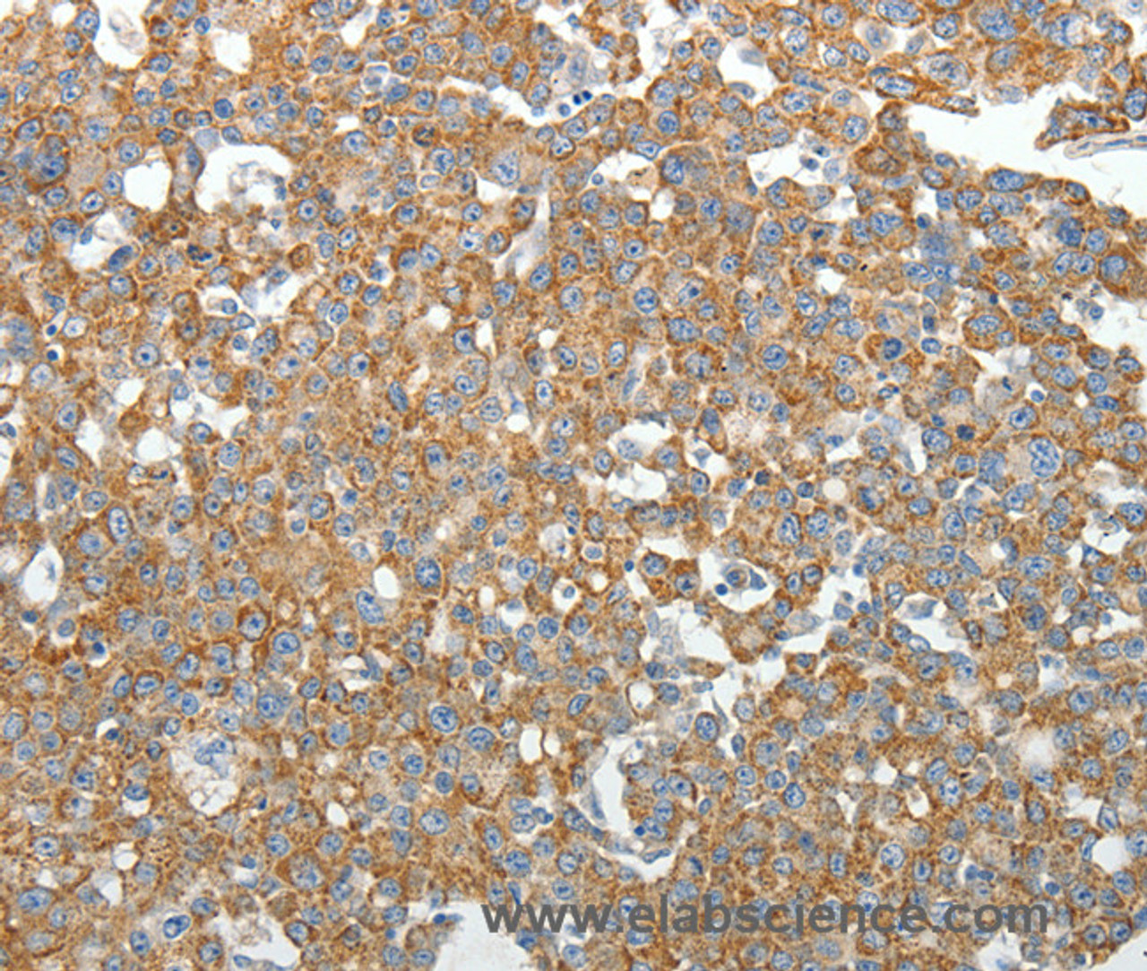 Immunohistochemistry of paraffin-embedded Human breast cancer tissue using GEMIN2 Polyclonal Antibody at dilution 1:40