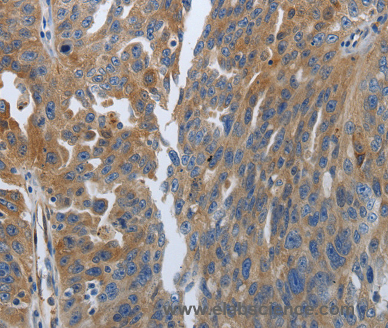 Immunohistochemistry of paraffin-embedded Human ovarian cancer using SOCS1 Polyclonal Antibody at dilution of 1:70
