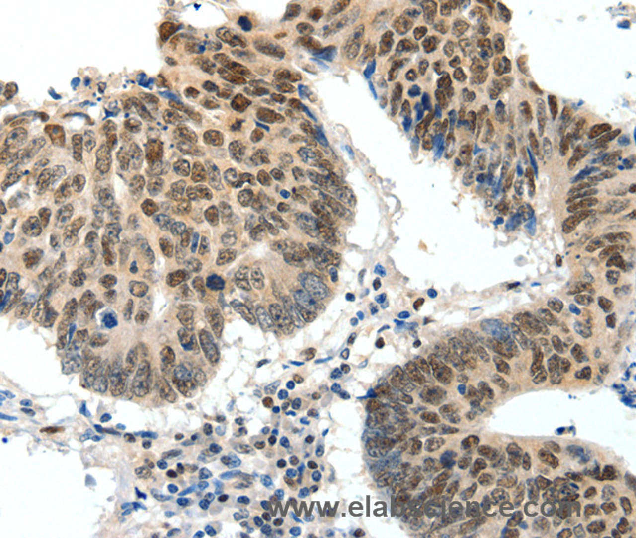 Immunohistochemistry of paraffin-embedded Human colon cancer tissue using TOP2A Polyclonal Antibody at dilution 1:30