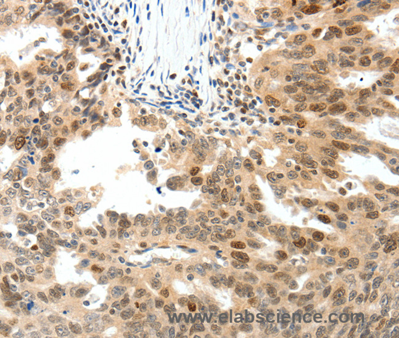 Immunohistochemistry of paraffin-embedded Human ovarian cancer tissue using TOP2A Polyclonal Antibody at dilution 1:30