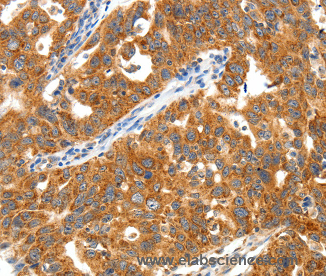 Immunohistochemistry of paraffin-embedded Human ovarian cancer using TRAF3 Polyclonal Antibody at dilution of 1:40