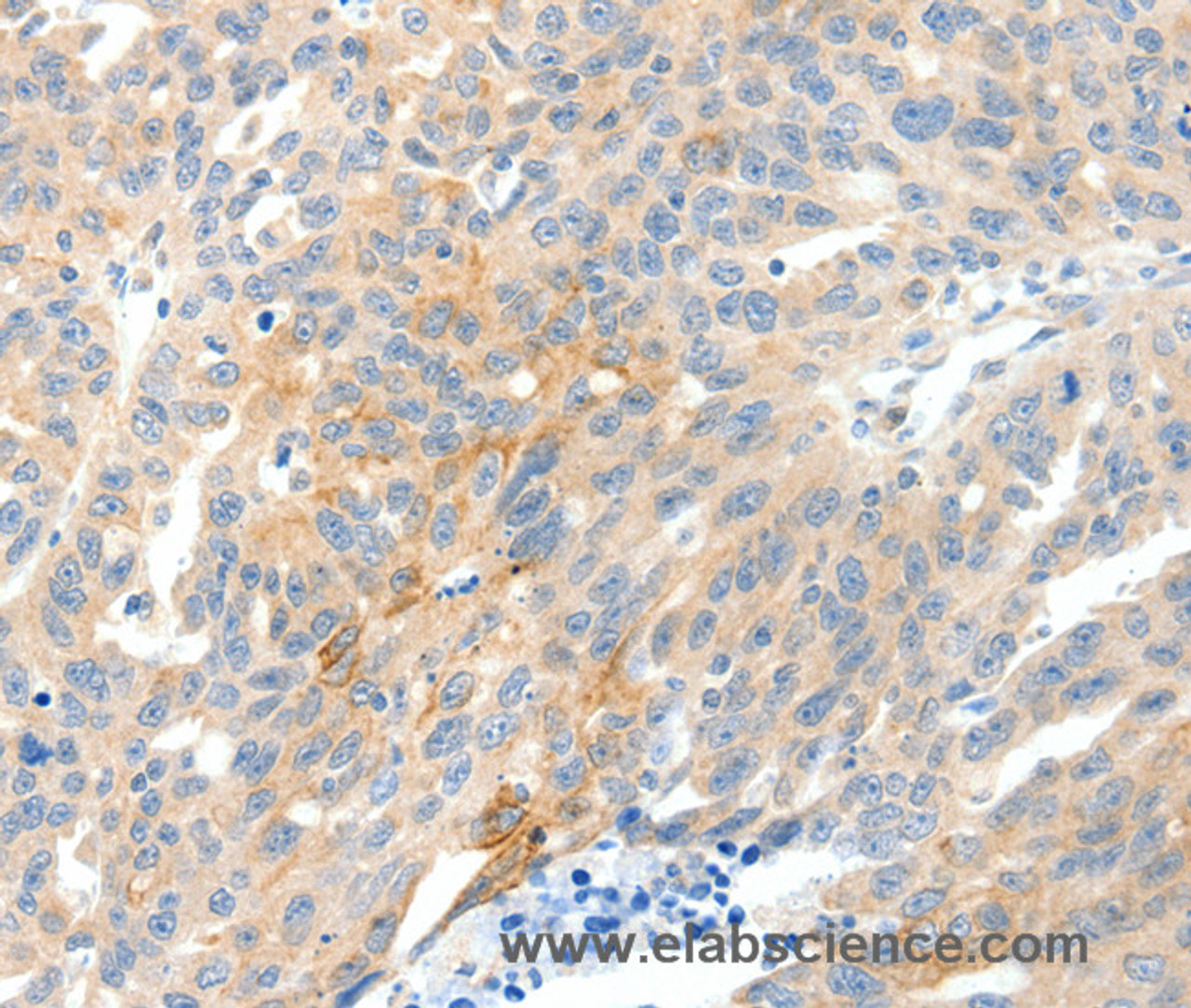 Immunohistochemistry of paraffin-embedded Human ovarian cancer tissue using NTRK1 Polyclonal Antibody at dilution 1:90