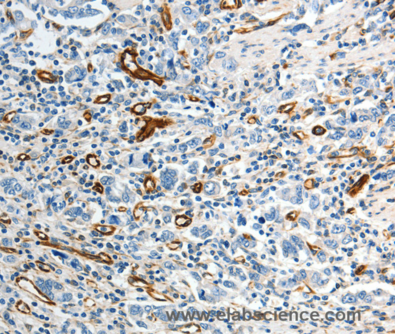 Immunohistochemistry of paraffin-embedded Human gastic cancer using ABCG1 Polyclonal Antibody at dilution of 1:40