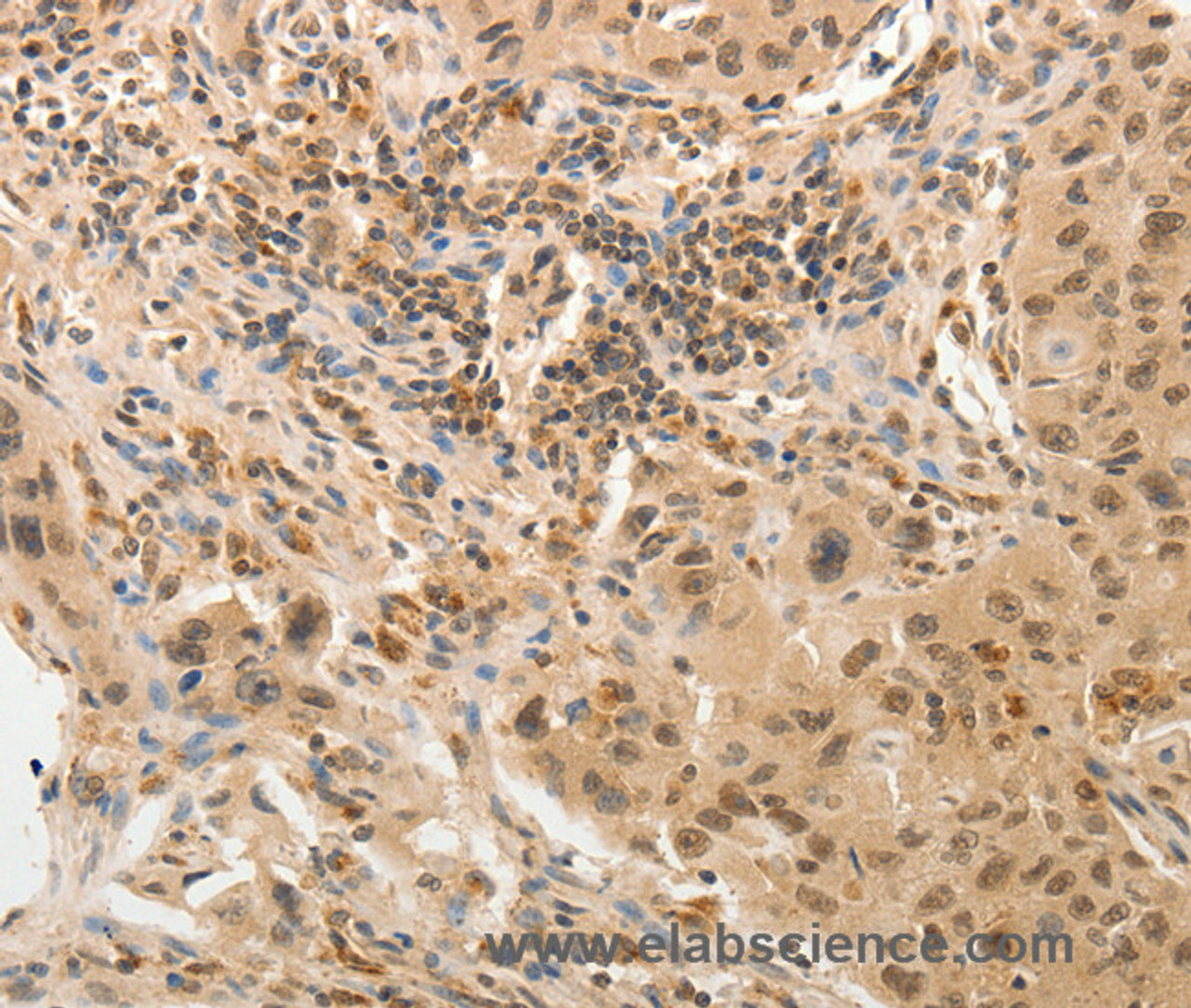 Immunohistochemistry of paraffin-embedded Human lung cancer tissue using ADAR Polyclonal Antibody at dilution 1:40